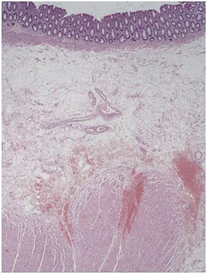 Stapled Hemorrhoidopexy: “Mucosectomy or Not Only Mucosectomy, This Is the Problem”
